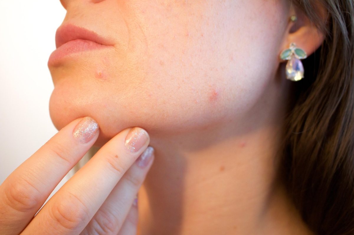 acne-1606765_1280 acne-1606765_1280